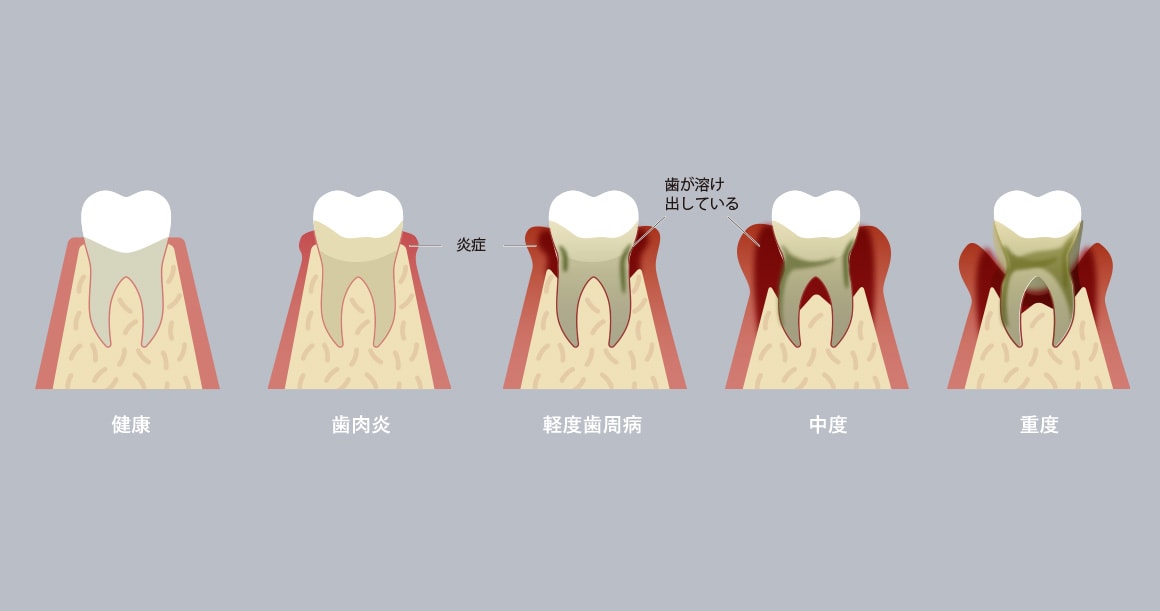 高度な専門性による歯周病治療